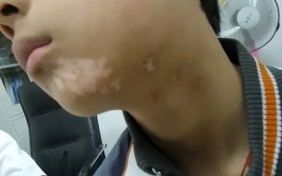 ​白癜风是什么病（白癜风是怎么引起的？什么方法可以治好白癜风？）