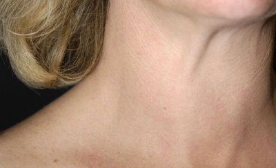 ​如何自检甲状腺疾病症状 怎样自检甲状腺