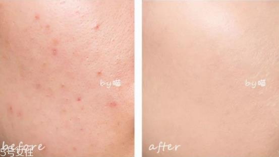遮痘印用哪款遮瑕最好 遮痘印化妆方法