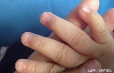 ​孩子手指甲出现白斑真的是肚子里有虫？这几类情况您应当分清楚