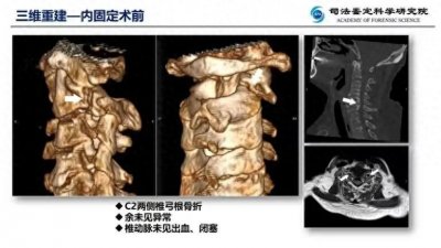 ​法医的虚拟解剖：揭开女子车祸死亡背后的真相