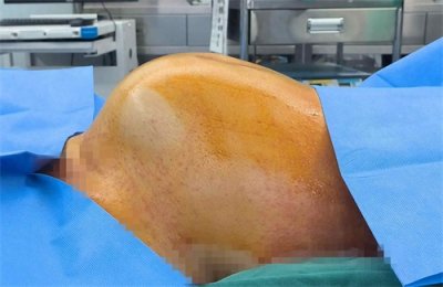 ​佛山女子误认“发福”10年，多学科联手切除近10斤肿瘤